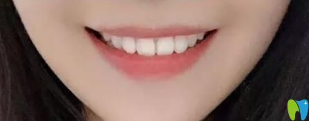 我在廣州柏德口腔做牙齒矯正1年