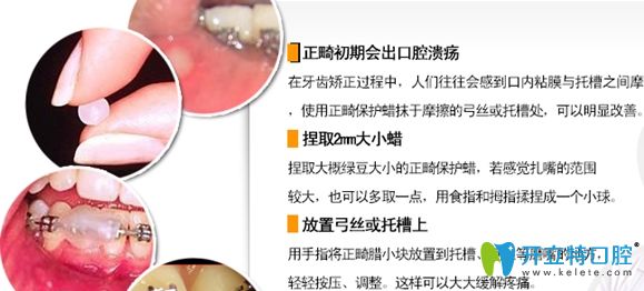 牙套托槽磨嘴怎么辦，可使用正畸蠟來保護口腔粘膜