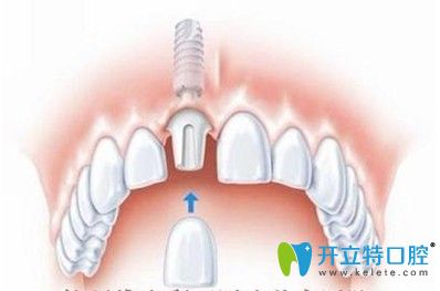 珠海仁愛口腔江榮強(qiáng)介紹種植牙術(shù)后注意事項(xiàng)