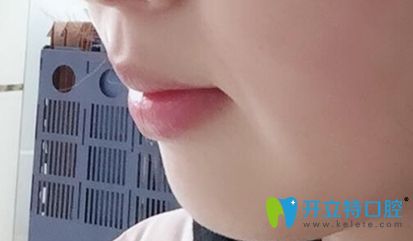 中信惠州口腔做完牙齒矯正的側(cè)面照 中信惠州口腔做完牙齒矯正的側(cè)面照