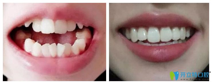 <!--<i data=20240703-sp></i>-->口腔隱形牙齒矯正<span style=