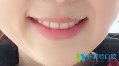 在中信惠州醫(yī)院牙科做完牙齒正畸后的樣子 在中信惠州醫(yī)院牙科做完牙齒正畸后的樣子