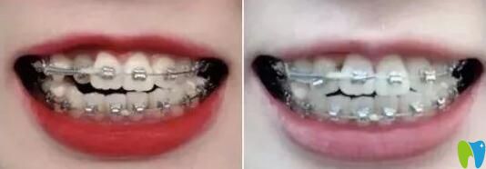 我在珠海仁愛口腔做牙齒矯正第7和第7個月 我在珠海仁愛口腔做牙齒矯正第7和第7個月