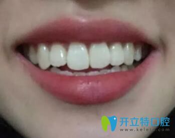 我在珠海仁愛口腔做牙齒矯正1年半 我在珠海仁愛口腔做牙齒矯正1年半