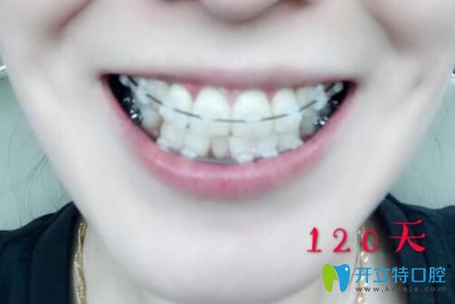 我在西安中諾口腔做陶瓷托槽矯正4個月