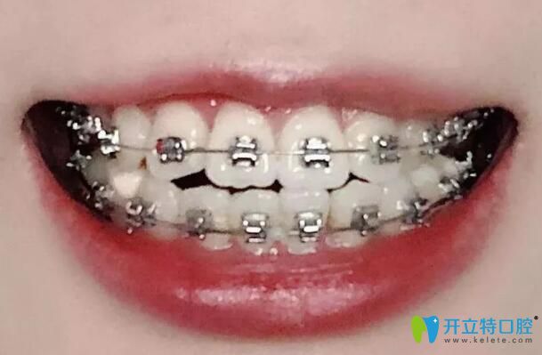 我在珠海仁愛口腔戴金屬牙套第12個月 我在珠海仁愛口腔戴金屬牙套第12個月