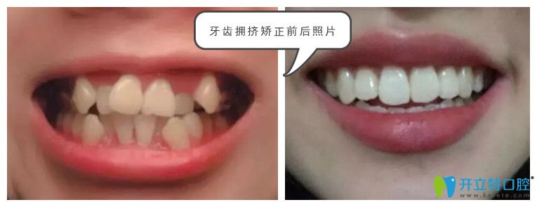珠海仁愛(ài)口腔牙齒矯正案例