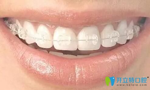西安中諾口腔劉列妮醫(yī)生科普牙齒矯正期間的注意事項(xiàng)