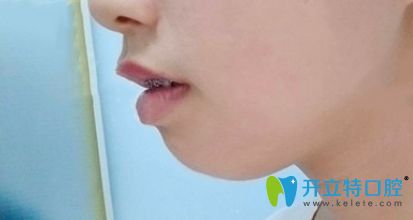 選擇在中信惠州醫(yī)院戴金屬自鎖托槽牙套矯正牙齒 選擇在中信惠州醫(yī)院戴金屬自鎖托槽牙套矯正牙齒