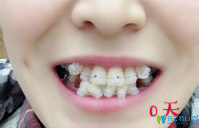 西安中諾口腔靠譜嗎?我做半隱形陶瓷牙齒矯正后來評(píng)價(jià)啦