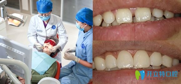 新鄉(xiāng)拜博口腔全瓷牙貼面修復(fù)效果圖