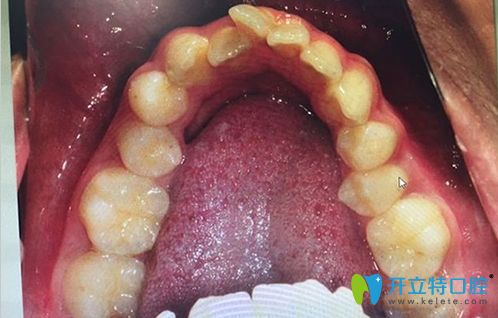 牙弓狹小需要擴弓的病例圖