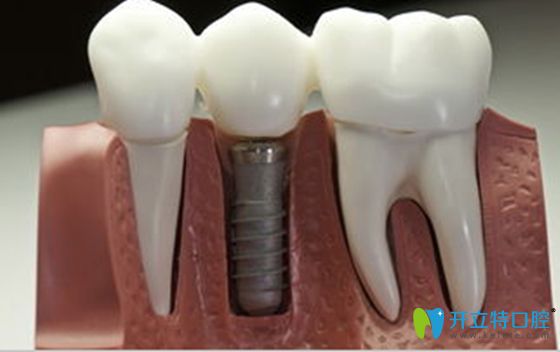 弄清韓國(guó)登騰種植牙很差的原因,就明白選登騰種植牙靠譜嗎?