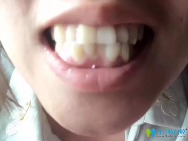 焦作哪里矯正牙齒好？拜博口腔牙齒矯正下牙套后經(jīng)歷分享