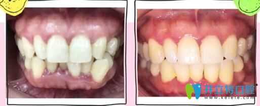 <!--<i data=20240703-sp></i>-->英博口腔牙齒擁擠不齊、咬合錯(cuò)亂矯正案例