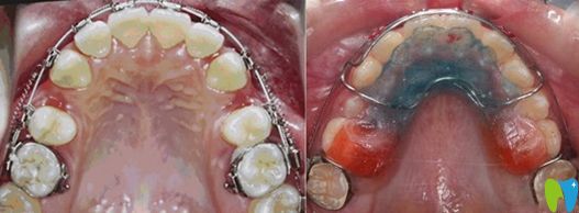 牙齒矯正擴牙弓和拔牙對比圖