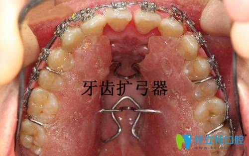 本想擴弓改變嘴凸,有人說牙齒擴弓后會更凸,真的嗎