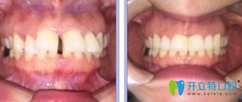 通過牙齒矯正案例及顧客評(píng)價(jià)來看看英博口腔怎么樣