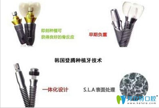 登騰種植牙價(jià)格合理效果不錯(cuò)