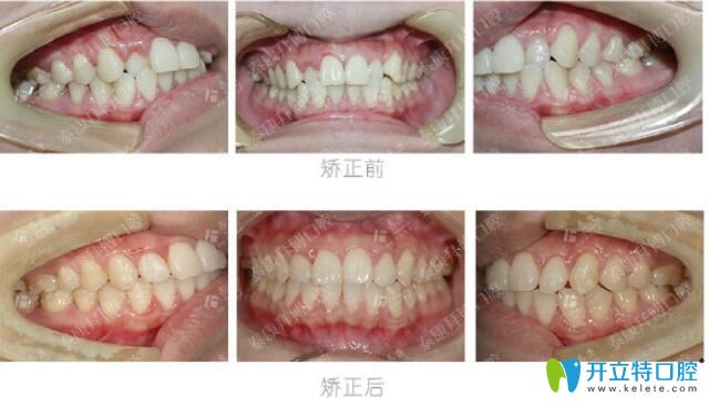 焦作拜博口腔個(gè)別牙齒反頜矯正案例