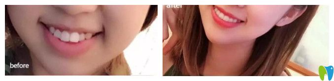 清華陽(yáng)光齙牙矯正案例圖