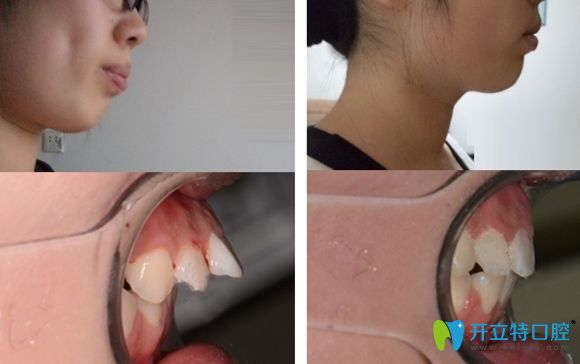 濟(jì)南韓氏口腔牙齒矯正改善突嘴暴牙案例效果圖 濟(jì)南韓氏口腔牙齒矯正改善突嘴暴牙案例效果圖