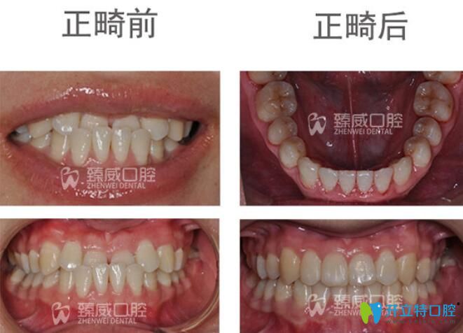 小姐姐矯正地包天后不僅牙齒變整齊了，臉型也有了很大的改變