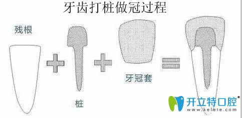 看了牙齒打樁的壞處,才明白朋友為啥后悔做了牙齒打樁做冠