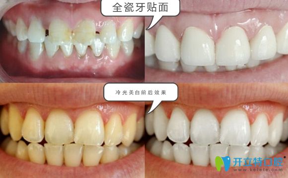 濟(jì)南韓氏口腔全瓷牙貼面和冷光美白效果圖 濟(jì)南韓氏口腔全瓷牙貼面和冷光美白效果圖