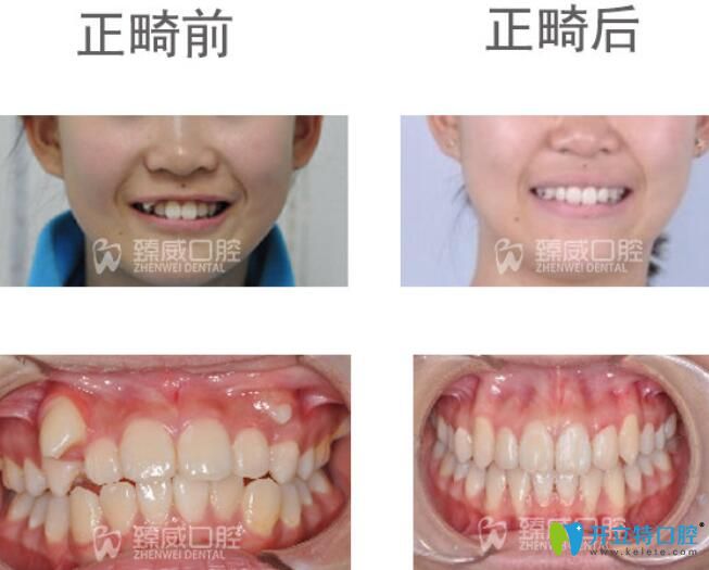 虎牙妹子在臻威口腔矯正虎牙案例前后效果對比