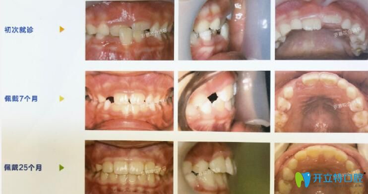 臻威口腔兒童羅慕咬合誘導(dǎo)早期干預(yù)矯正個別反頜牙齒案例