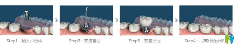 維嘉口腔種植牙過程圖示 維嘉口腔種植牙過程圖示
