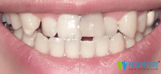 牙齒沒做矯正之前圖示