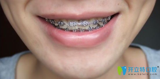 牙齒矯正一年三個月后的樣子圖