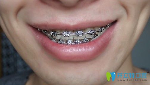 矯正5個月后的效果圖