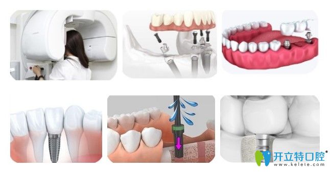 維嘉口腔種植牙流程