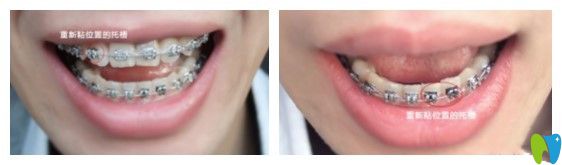 第七次復(fù)診牙齒的樣子