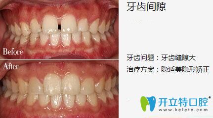 我在深圳弘和口腔做隱形矯正前后照片