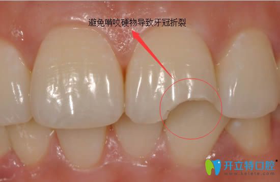 劉建君醫(yī)師講解前牙種植后的日常維護(hù)