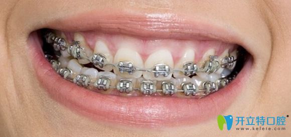 鋼絲托槽牙套效果圖