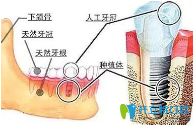 常用的人工種植牙技術(shù)有哪些？請看種植牙技術(shù)排名	