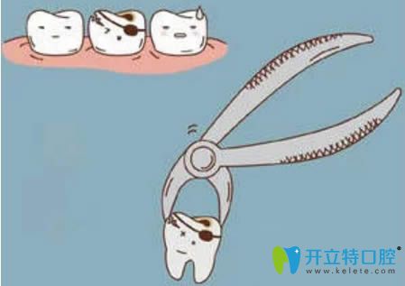 拔牙后多久可以刷牙呢