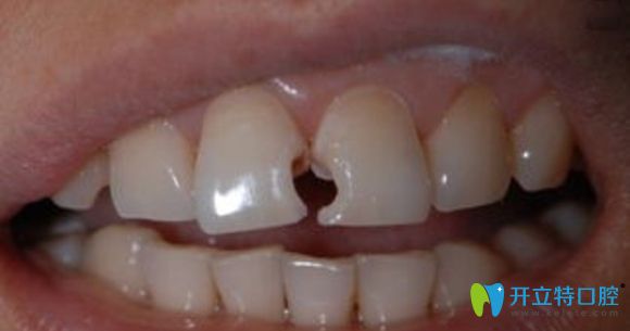 牙體缺損修復(fù)方式中樹脂貼面與全瓷牙貼面你會(huì)寵愛哪個(gè)?