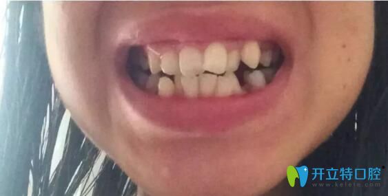 在武漢華美矯正擁擠不齊的牙齒時(shí)我還懷孕了，現(xiàn)已下牙套