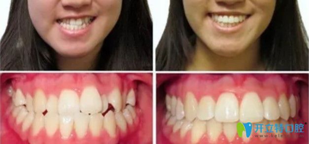 中諾口腔牙齒反頜案例圖