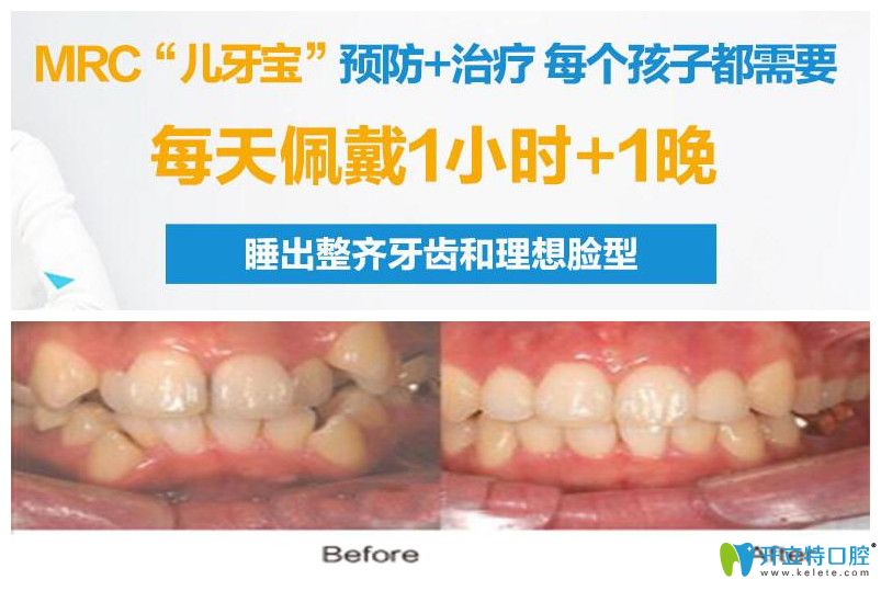 兒童乳牙反頜早期干預(yù)矯正案例