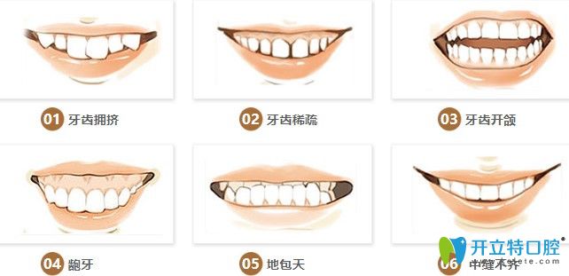 哪些牙齒需要做矯正圖示