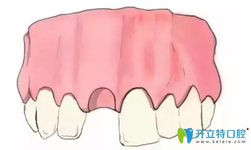 揭開天津中諾口腔種植牙全過程,含單顆/多顆和全口義齒種植