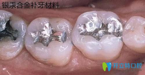 銀汞合金補牙材料