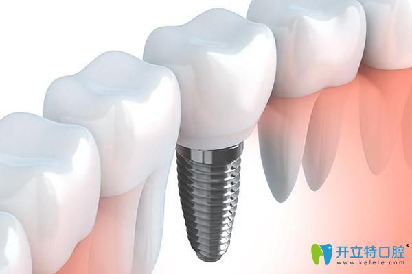 寧波恒美口腔徐路路科普種植牙術(shù)后注意事項 寧波恒美口腔徐路路科普種植牙術(shù)后注意事項